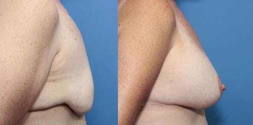 Breast Lift with Augmentation Before & After Gallery - Patient 58490411 - Image 2