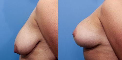 Breast Lift with Augmentation Before & After Gallery - Patient 58490413 - Image 2