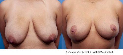 Breast Lift with Augmentation Before & After Gallery - Patient 58490413 - Image 1