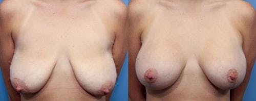 Breast Lift with Augmentation Before & After Gallery - Patient 58490414 - Image 1