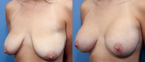 Breast Lift with Augmentation Before & After Gallery - Patient 58490414 - Image 2