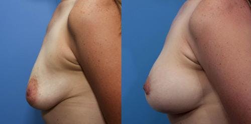 Breast Lift with Augmentation Before & After Gallery - Patient 58490418 - Image 2
