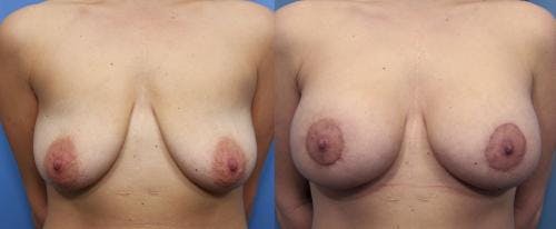 Breast Lift with Augmentation Before & After Gallery - Patient 58490420 - Image 1