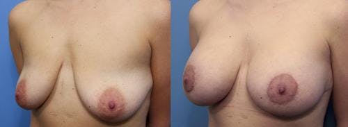 Breast Lift with Augmentation Before & After Gallery - Patient 58490420 - Image 2