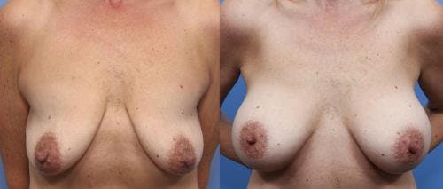 Breast Lift with Augmentation Before & After Gallery - Patient 58490421 - Image 1