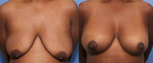 Breast Lift with Augmentation Before & After Gallery - Patient 58490426 - Image 1