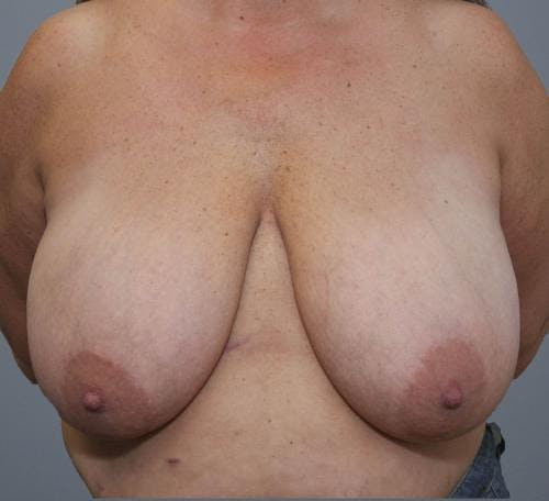 Breast Reduction Before & After Gallery - Patient 58490432 - Image 1