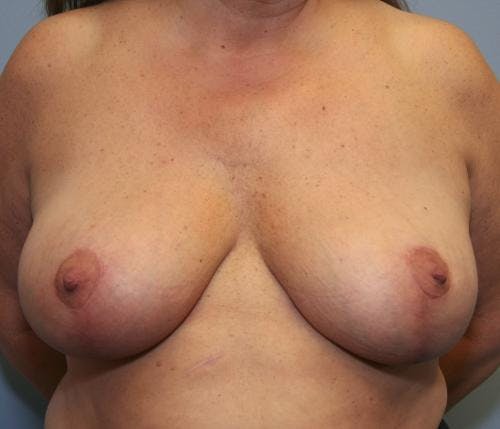 Breast Reduction Before & After Gallery - Patient 58490432 - Image 2