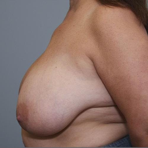 Breast Reduction Before & After Gallery - Patient 58490432 - Image 5