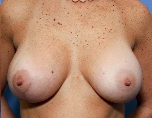 Breast Lift with Augmentation Before & After Gallery - Patient 58490433 - Image 4