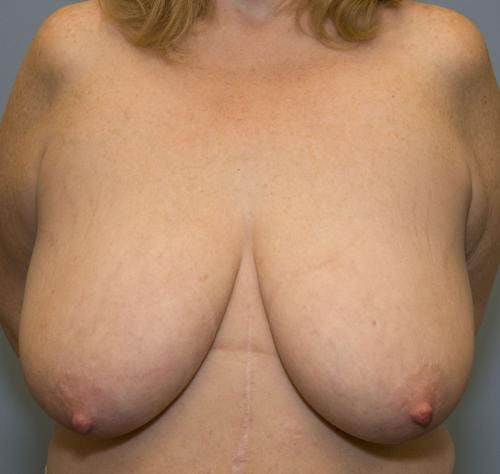 Breast Reduction Before & After Gallery - Patient 58490434 - Image 1