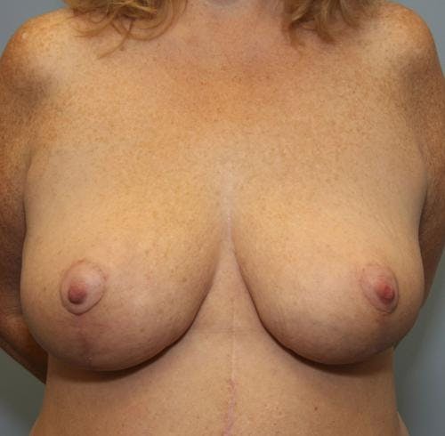 Breast Reduction Before & After Gallery - Patient 58490434 - Image 2