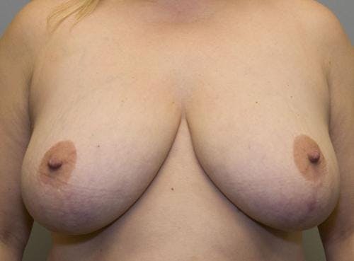 Breast Reduction Before & After Gallery - Patient 58490436 - Image 1