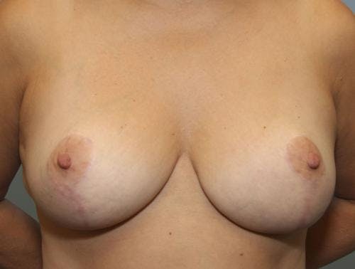 Breast Reduction Before & After Gallery - Patient 58490436 - Image 2