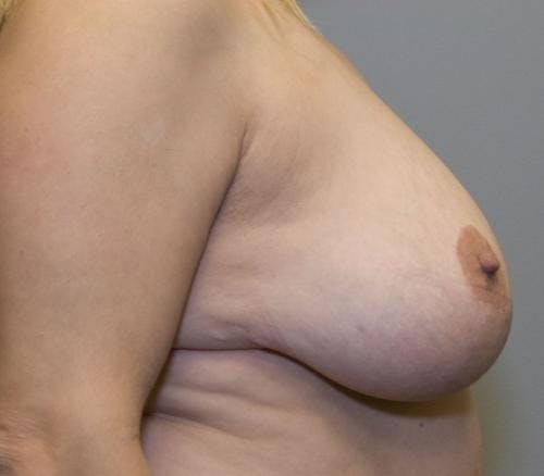 Breast Reduction Before & After Gallery - Patient 58490436 - Image 3