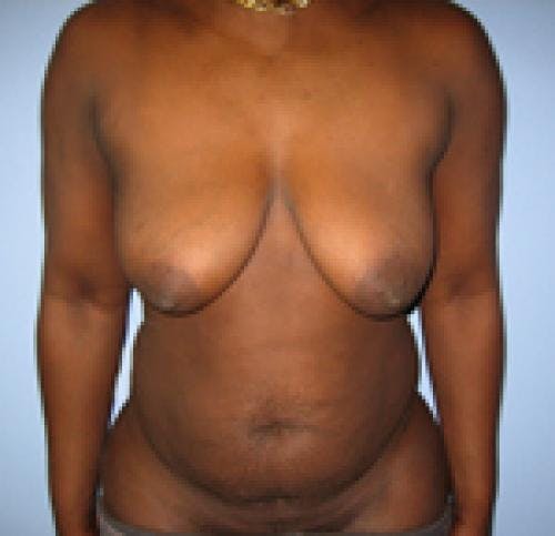Breast Lift with Augmentation Before & After Gallery - Patient 58490437 - Image 1