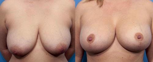 Breast Lift with Augmentation Before & After Gallery - Patient 58490444 - Image 1