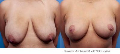 Breast Lift with Augmentation Before & After Gallery - Patient 58490447 - Image 1
