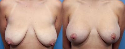 Breast Lift with Augmentation Before & After Gallery - Patient 58490448 - Image 1