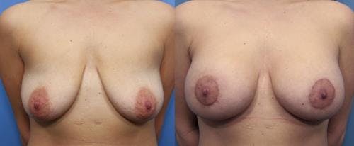 Breast Lift with Augmentation Before & After Gallery - Patient 58490450 - Image 1