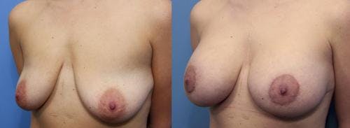 Breast Lift with Augmentation Before & After Gallery - Patient 58490450 - Image 2