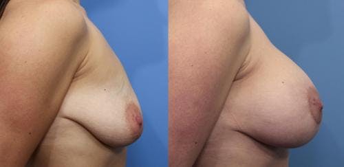 Breast Lift with Augmentation Before & After Gallery - Patient 58490450 - Image 3