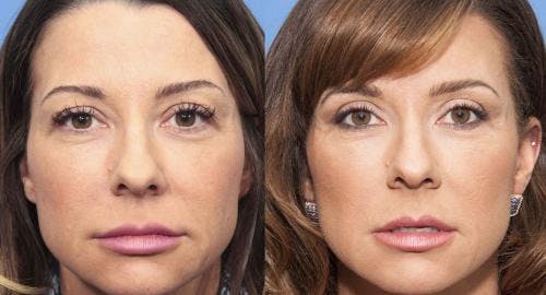 Eyelid Surgery (Upper Blepharoplasty) Before & After Gallery - Patient 58490455 - Image 1