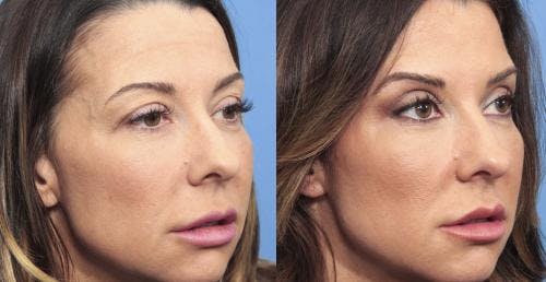 Eyelid Surgery (Upper Blepharoplasty) Before & After Gallery - Patient 58490455 - Image 2