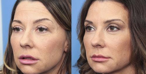 Eyelid Surgery (Blepharoplasty) Before & After Gallery - Patient 58490455 - Image 3