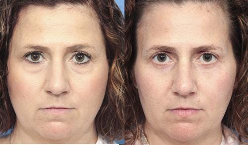 Eyelid Surgery (Blepharoplasty) Before & After Gallery - Patient 58490458 - Image 1