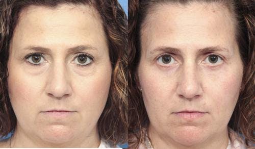 Eyelid Surgery (Lower Blepharoplasty) Before & After Gallery - Patient 664935 - Image 1