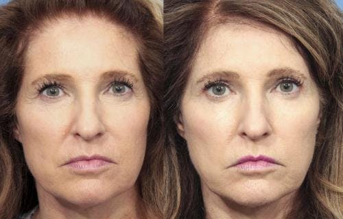 Eyelid Surgery (Upper Blepharoplasty) Before & After Gallery - Patient 58490459 - Image 1
