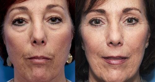 Eyelid Surgery (Upper & Lower Blepharoplasty) Before & After Gallery - Patient 600964 - Image 1