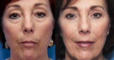 Eyelid Surgery (Upper & Lower Blepharoplasty) Before & After Gallery - Patient 600964 - Image 1