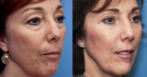 Eyelid Surgery (Upper & Lower Blepharoplasty) Before & After Gallery - Patient 600964 - Image 2