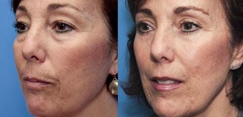 Eyelid Surgery (Upper & Lower Blepharoplasty) Before & After Gallery - Patient 600964 - Image 3