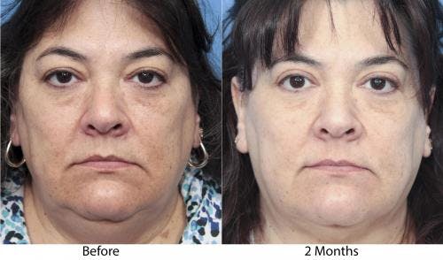 Eyelid Surgery (Blepharoplasty) Before & After Gallery - Patient 58490463 - Image 1