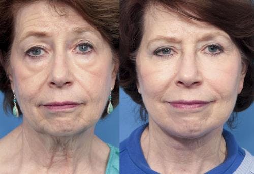 Eyelid Surgery (Upper & Lower Blepharoplasty) Before & After Gallery - Patient 271642 - Image 1