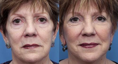 Face Lift Before & After Gallery - Patient 58490467 - Image 1