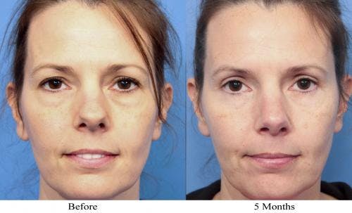 Eyelid Surgery (Upper & Lower Blepharoplasty) Before & After Gallery - Patient 643772 - Image 1