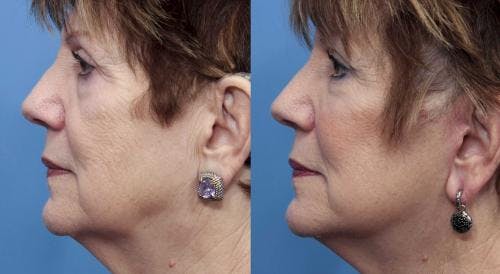 Face Lift Before & After Gallery - Patient 58490467 - Image 3
