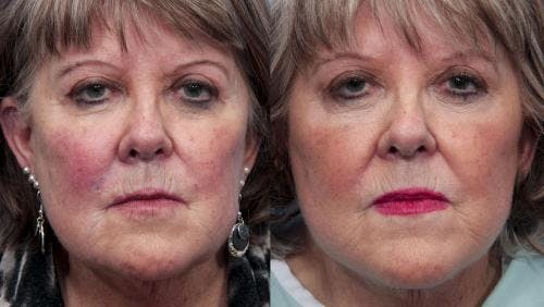 Face Lift Before & After Gallery - Patient 58490469 - Image 1