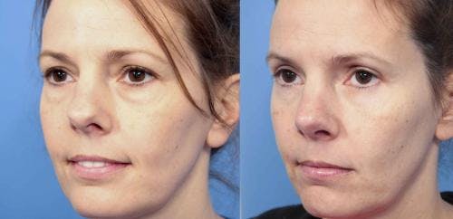 Eyelid Surgery (Blepharoplasty) Before & After Gallery - Patient 58490468 - Image 3