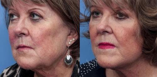 Face Lift Before & After Gallery - Patient 58490469 - Image 2