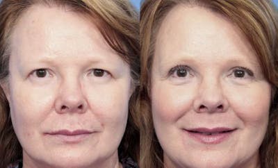 Eyelid Surgery (Upper Blepharoplasty) Before & After Gallery - Patient 58490470 - Image 1