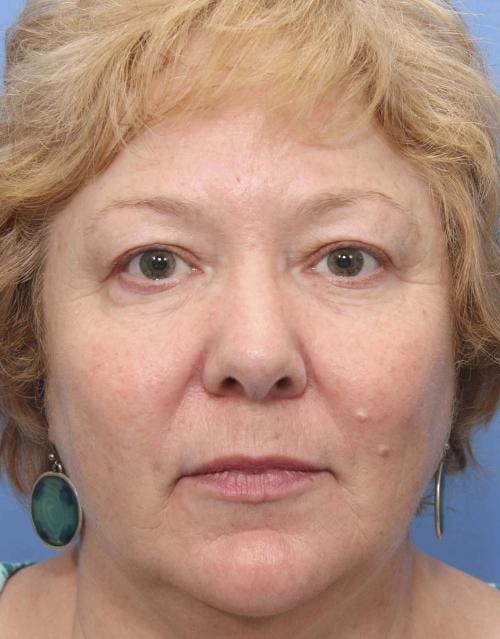 Face Lift Before & After Gallery - Patient 58490475 - Image 1