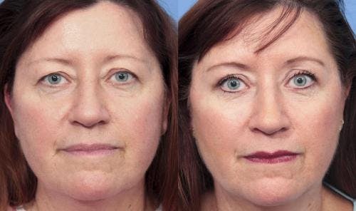 Eyelid Surgery (Blepharoplasty) Before & After Gallery - Patient 58490471 - Image 1