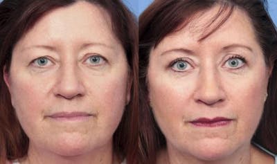Eyelid Surgery (Upper Blepharoplasty) Before & After Gallery - Patient 58490471 - Image 1