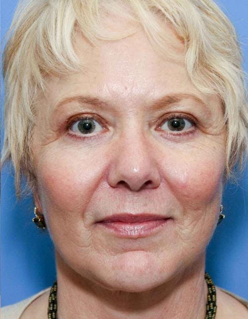 Face Lift Before & After Gallery - Patient 58490475 - Image 2