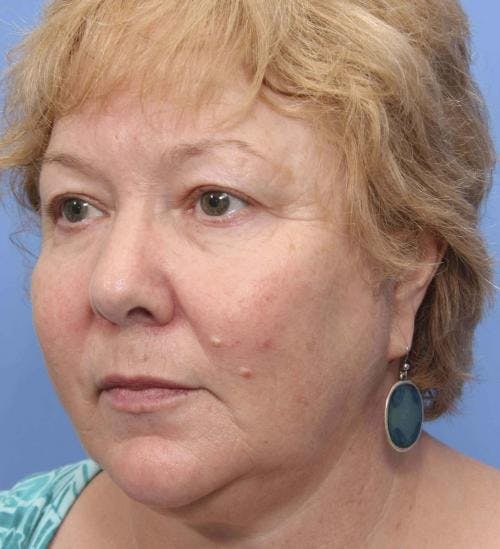 Face Lift Before & After Gallery - Patient 58490475 - Image 3